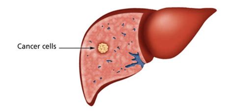 Liver Cancer Creative Diagnostics