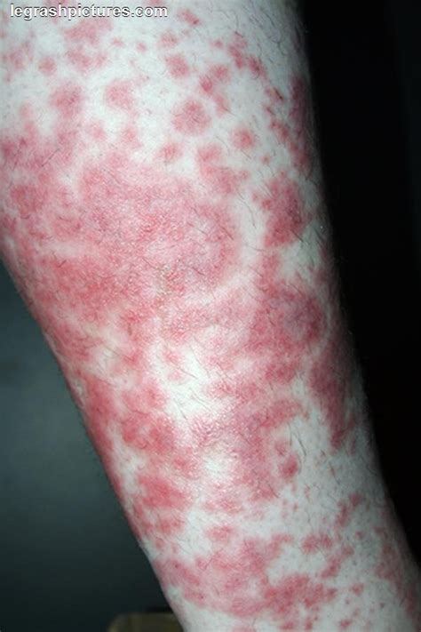 Rash On Legs Looks Like Pimples Printable Templates Protal