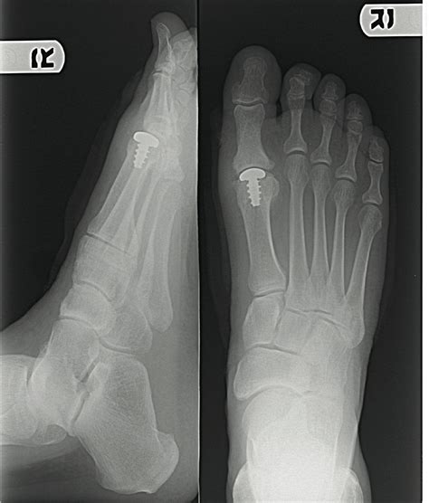 Cure Hallux Rigidus Naturally at Anna Dolby blog