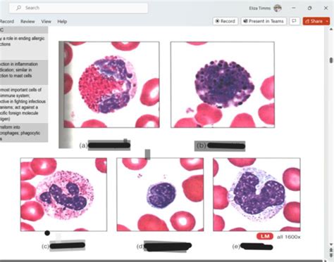 Heme Onc Diagnostics Flashcards Quizlet