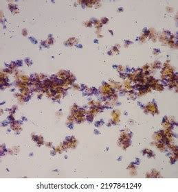 Abnormal Squamous Epithelial Cells View Microscopy Stock Photo ...