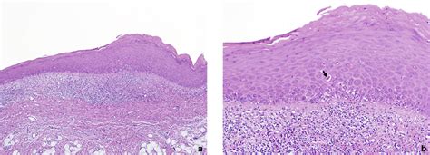 Oral Lichen Planus Opmdcare