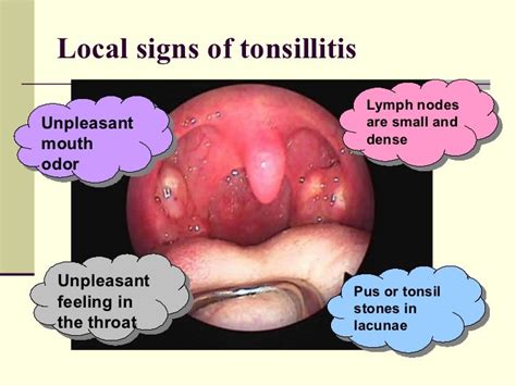 Symptoms Of Tonsil Cancer