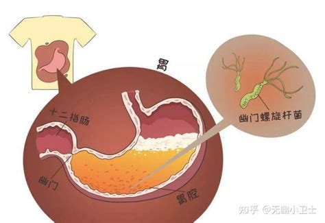 幽门螺杆菌的正常值是多少？ 知乎