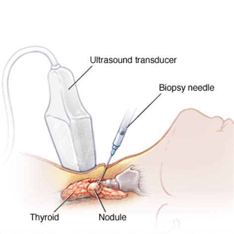 Baaf De Tiroides Biopsia Por Aspiraci N Con Aguja Fina En Chiclayo Per