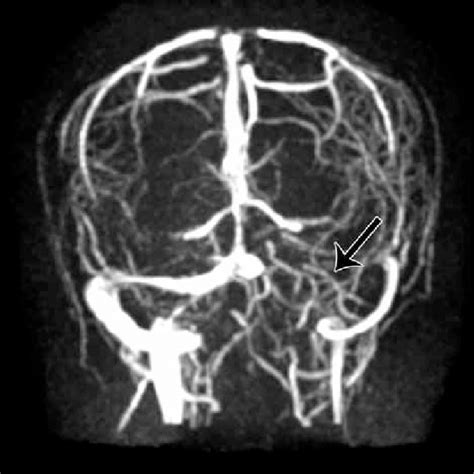 Magnetic Resonance Venography Showing Thrombosis Of Anterior Part Of