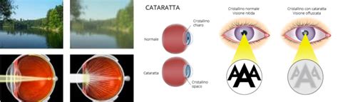 Cataratta Stefano Ferrandi Oculista Milano E Lecco