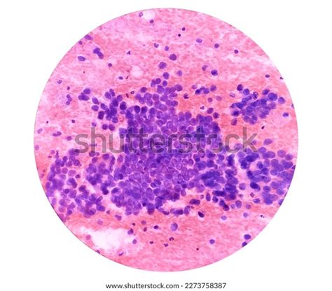 Photomicrograph Fine Needle Aspiration Fna Cytology Stock Photo