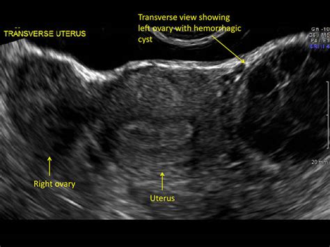 Hemorrhagic Corpus Luteum Ultrasound