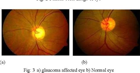 Figure From Classification Of Glaucoma Using K Mean Clustering With