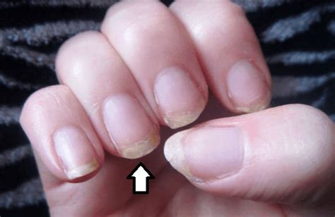 Acrylic Nail Fungus: I Have the Answers