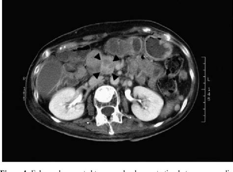 Figure 1 From Obstructive Jaundice In A Metastatic Tumor Of The