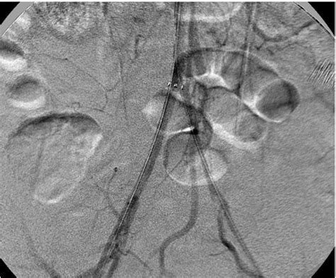 Leriche Syndrome: Percutaneous Treatment with Mechanical Thrombectomy ...