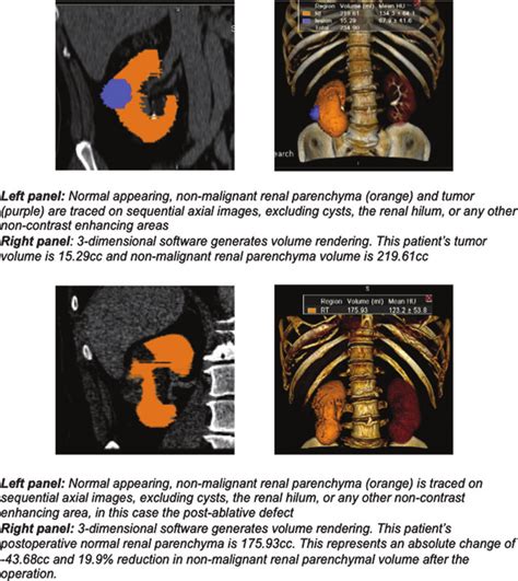 Example Of Pre And Postoperative Renal Parenchymal Volume And Tumor