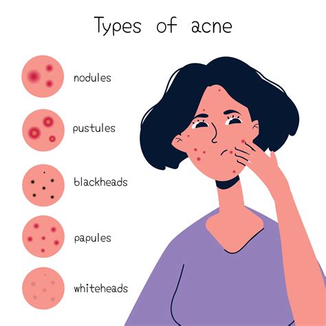 Acne Types Chart Vector Art At Vecteezy