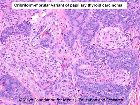 Unique Clinical Significance Of The Cribriform Morular Variant Of