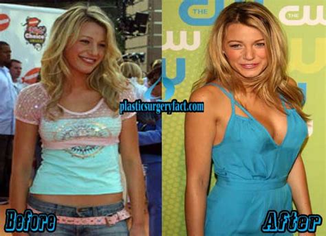 Blake Lively Plastic Surgery Before and After Photos