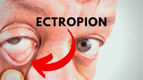 Ectropion Dr Anthony Maloof