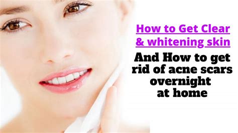 How To Get Rid Of Acne Scars Overnight Get Clear And Whitening Skin