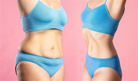 Tummy Tuck In Turkey Abdominoplasty Bookmedi Clinic