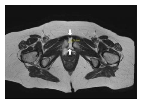 MRI of the pelvis. (a) Axial MRI presenting extensive widening of the ...