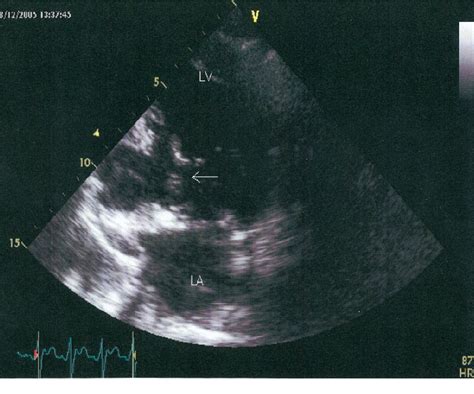 Figure From Left Ventricular Pseudoaneurysm With Interventricular