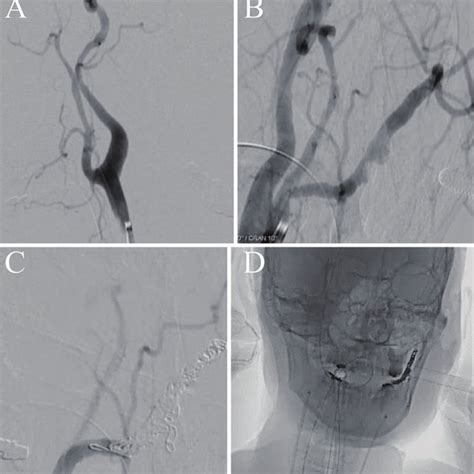 Angiogram Of Endovascular Therapy A Right Common Carotid Artery