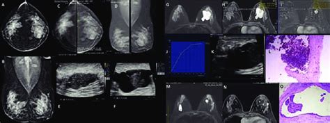 A A 44 Year Old Lady Presented With Palpable Lump In Left Breast