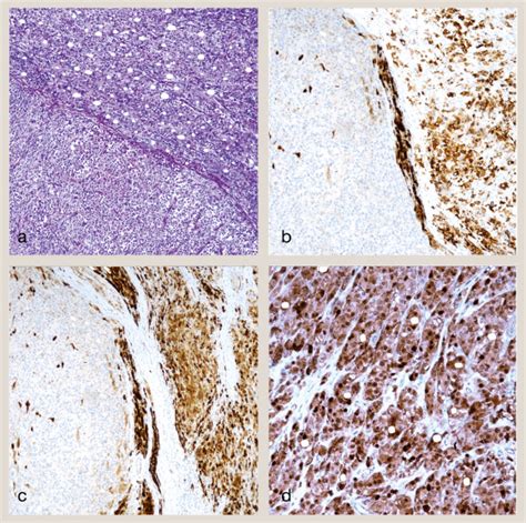 Leydig Sertoli Collision Sex Cord Stromal Tumor Of The Testis A Case