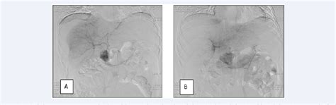 Figure 1 From Therapy Of Liver Subcapsular Giant Hematoma With Hellp Syndrome Case Report And