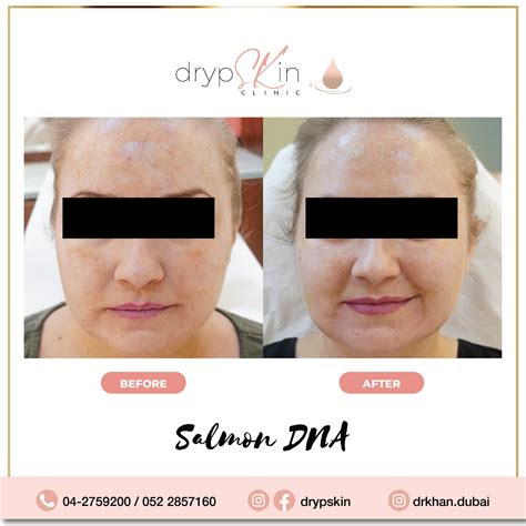 Salmon Dna Injections Salmon Dna Dubai Drypskin