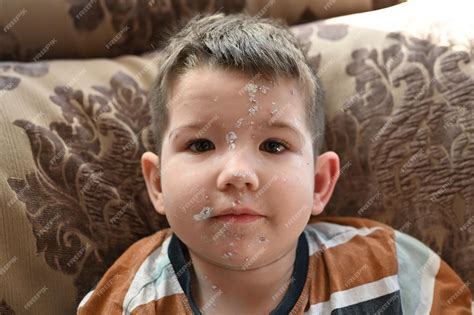 Premium Photo Little Boy With An Allergic Rash On His Face Kid Boy