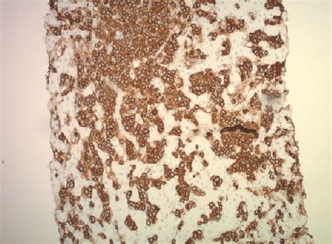 Cd Immunostaining Highlights The Atypical Lymphoproliferation