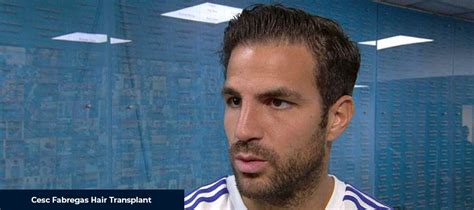 Cesc Fabregas Hair Loss