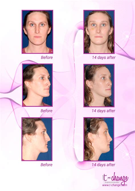 Facial Feminization Surgery Ffs Blog T Change