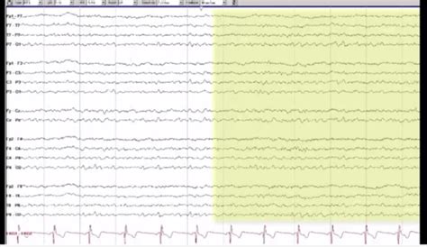 EEG Flashcards Quizlet