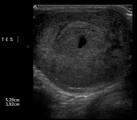 Yolk Sac Tumor Testicular Cancer