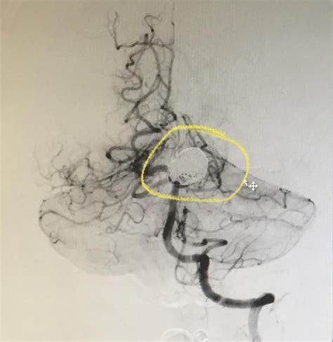 My ruptured brain aneurysm : r/Radiology