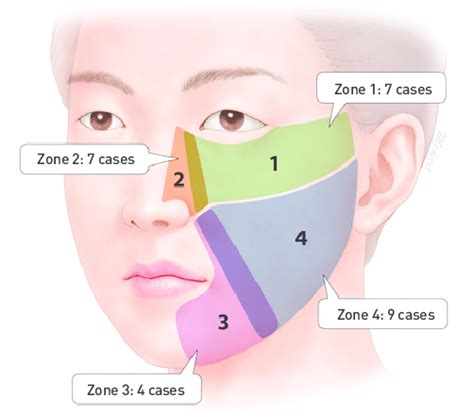 Schematic diagram. Four subdivisions of the cheek. The surgical defect ...