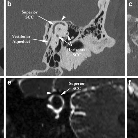 Normal Superior Semicircular Canal Ssc Coronal A Parallel B