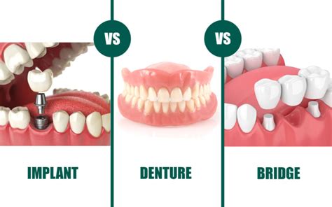 What Is A Dental Plate Royal Dental Clinics Blog