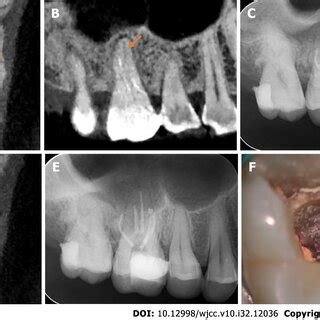 X Ray And An Intraoral Photograph Showing The Treatment Process Of The