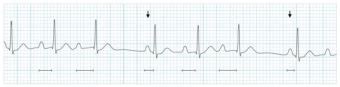 Diagnosis, Wenckebach? • LITFL • Clinical Cases ECG Exigency