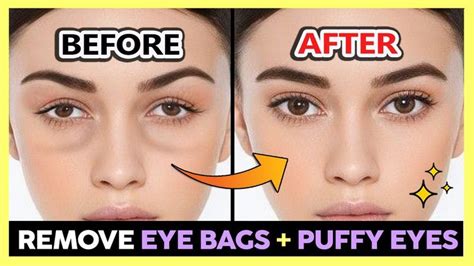 REMOVE UNDER EYE BAGS, PUFFY EYES, SWOLLEN EYES PERMANENTLY | GET BRIGHT EYES & BEAUTIFUL EYES ...