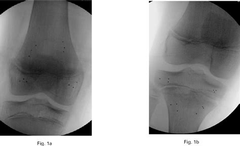 Figure 1 From Radiostereometric Analysis For Monitoring Percutaneous