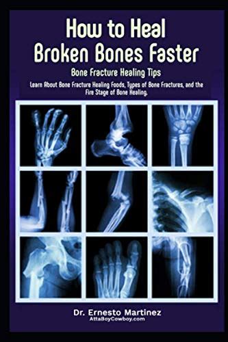 How to Heal Broken Bones Faster. Bone Fracture Healing Tips: Learn ...