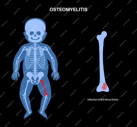 Enfermedad De Osteomielitis En Niños Hueso Infectado De La Pierna La