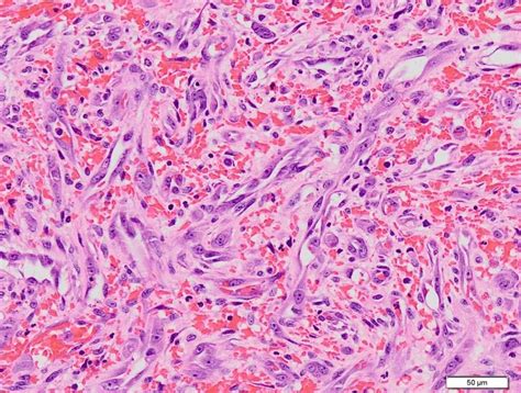 Angiosarcoma Histology