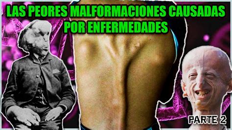 Las Malformaciones Mas Terribles Causadas Por Enfermedades 2 YouTube