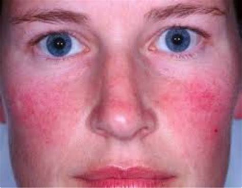 Rosacea And Dry Eye Problems Home